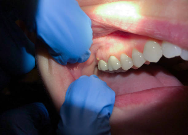 Best Dental Abscess Treatment in Tipton, CA